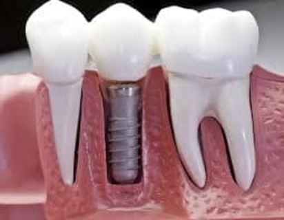 Medical supplies article on dental implants