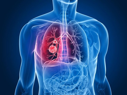 Medical supplies article on mesothelioma