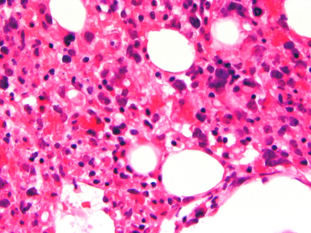 Bone Marrow Biopsy Pain