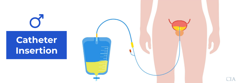 How to insert a catheter male patient